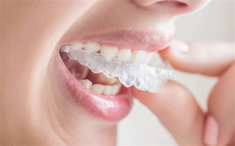 Invisalign® Braces in Cincinnati, OH | Boley Braces