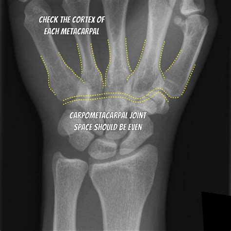 EMRad: Radiologic Approach to the Traumatic Wrist