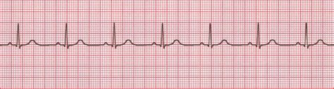 Electrocardiogram (ECG)