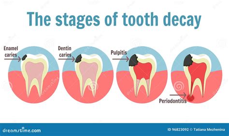 The Stages of Tooth Decay Infographic. Dental Toothache Symbol Stock ...