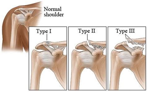 AC Joint Separation | Brisbane Knee and Shoulder Clinic | Dr ...