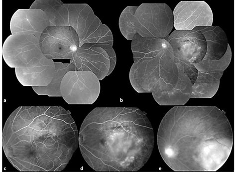 Fluorescein angiography images (a right eye, b-e left eye). The ...