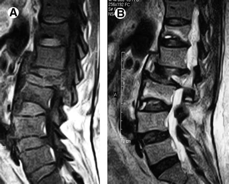 Osteoporotic compression fracture of T12, L2, and L3 vertebrae in a ...