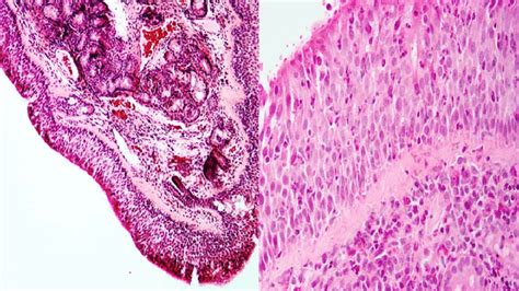 Nasal Turbinate Histology