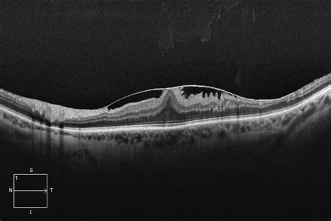 Epiretinal Membrane (ERM) | Qld Eye & Retina Specialists | Brisbane