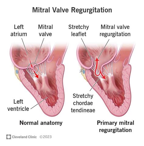 Mitral Valve Regurgitation: Symptoms & Causes