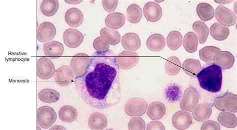 Monocyte : Cell is larger - Lower N/C ratio - Finer nuclear chromatin ...