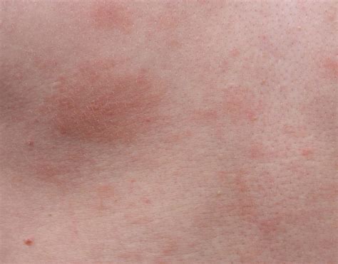 What Is a Deodorant Rash? (with pictures)