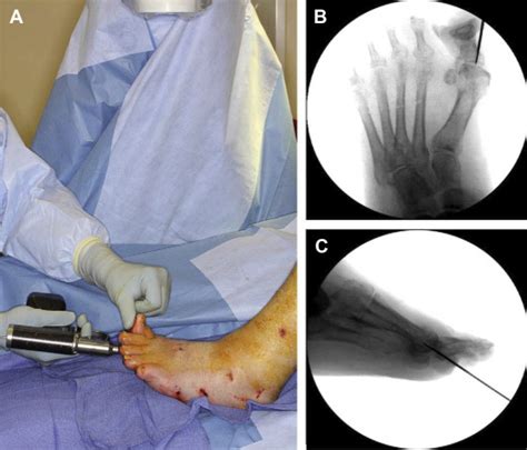 Midfoot Charcot Reconstruction - Clinics in Podiatric Medicine and Surgery