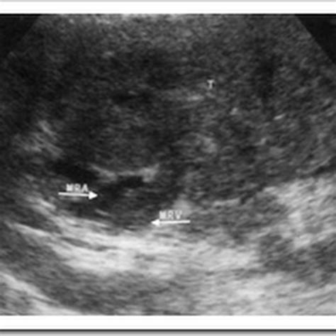 Ultrasound images of Renal cell carcinoma (RCC) - Radiology Imaging