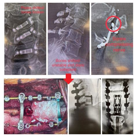 Before & After: Procedure called a Laminoplasty Laminosplasty