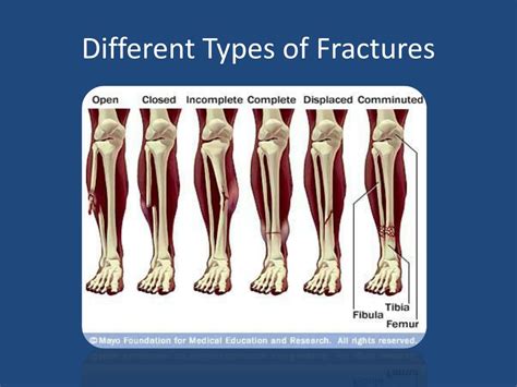 Ppt Principles Of Fractures Fracture Management Powerpoint | The Best ...