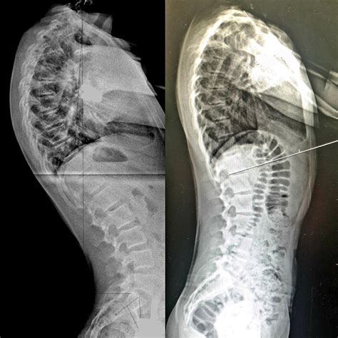 Kyphosis - Schroth method for Scheuermann's kyphosis