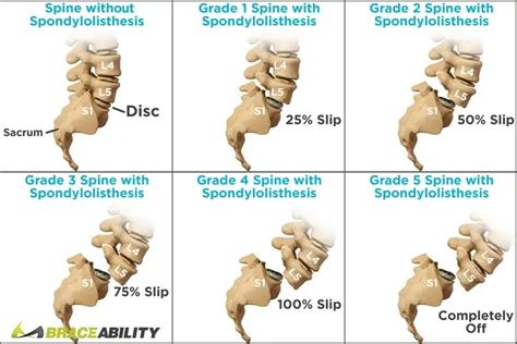 What is Spondylolisthesis - Arthritic Chick