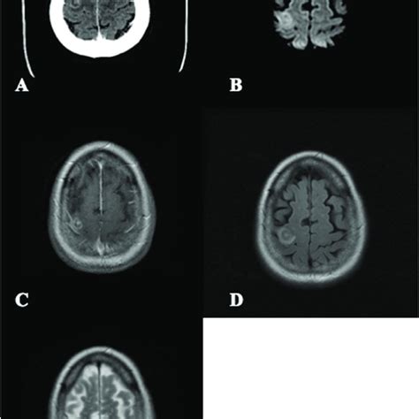 (PDF) Fatal Balamuthia mandrillaris brain infection associated with ...