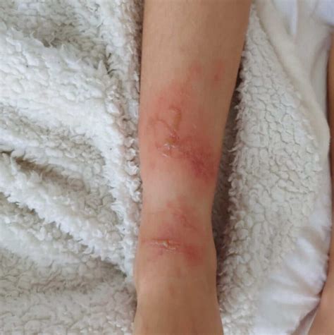 Jellyfish Stings In Children And Adults