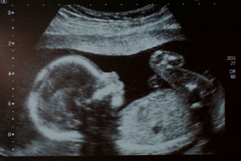 Nuchal Translucency Scan | Queensland X-Ray