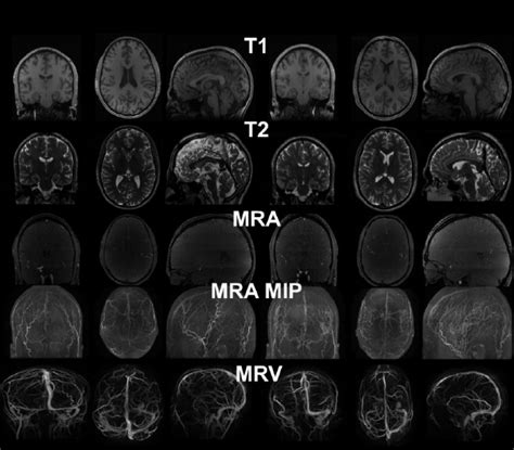 MRI images from two healthy subjects. T1 provides distinction of grey ...