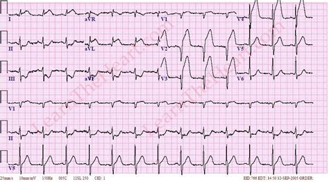 Anterior Wall ST Segment Elevation Myocardial Infarction (MI) ECG ...