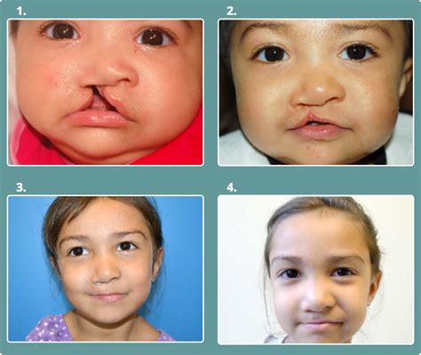 Cleft Lip & Cleft Palate | Green Park Dental Hospital