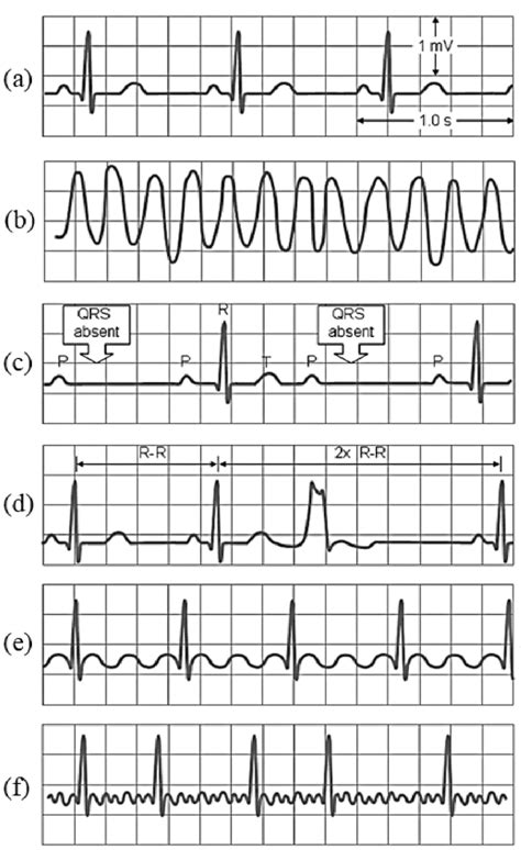 Common Examples Of Abnormal Ecgs A Normal Sinus Rhythm B Images | The ...