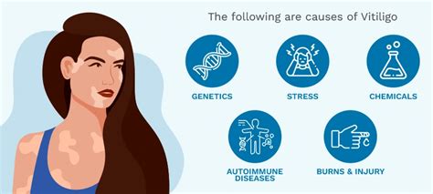 Vitiligo Treatment - Causes, Types & Symptoms | Dr Batra’s™