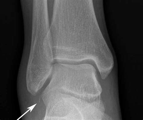 RiT radiology: Fracture of the Lateral Process of Talus