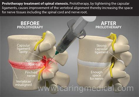 Non-surgical treatment options for lumbar spinal stenosis in 2020 ...