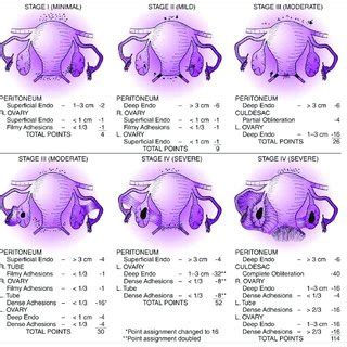 Stages of endometriosis. Source:... | Download Scientific Diagram