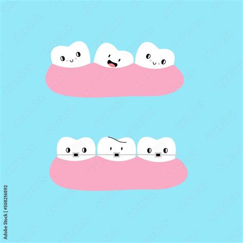 Cartoon Teeth in gum. Straight and crooked teeth. Braces before and ...