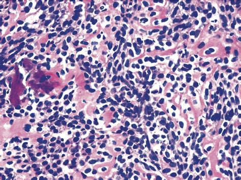 Histology Of Osteosarcoma