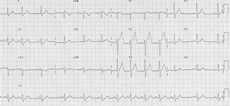 Sinus Arrhythmia • LITFL Medical Blog • ECG Library Basics