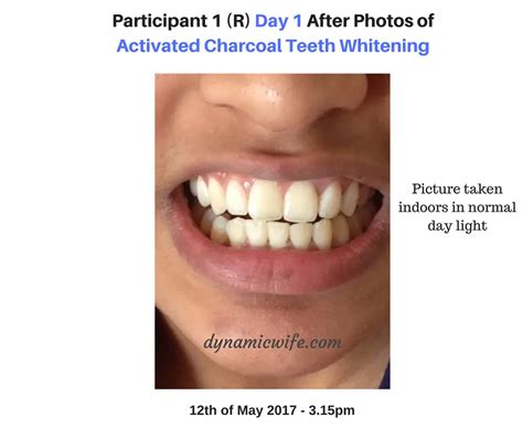 Activated Charcoal Teeth Whitening Experiment -2 REAL Before/After Pics