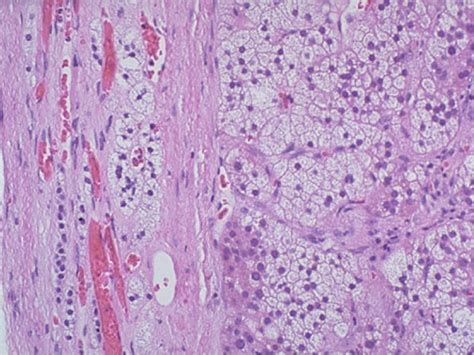 Adrenal Cortical Adenoma