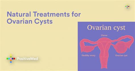 Natural Treatments for Ovarian Cysts