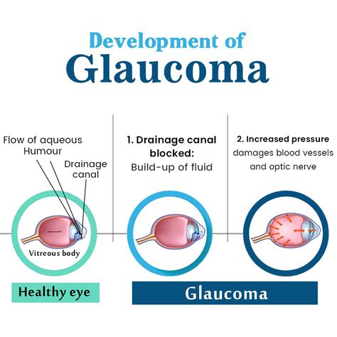 Glaucoma Surgery in Jalandhar, Punjab | Glaucoma Treatment Cost in Phagwara