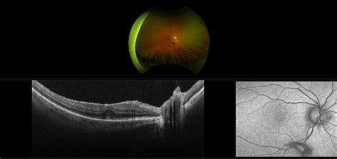 Epiretinal Membrane