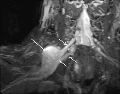 Brachial Plexus Mri