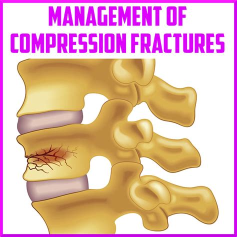 Management of vertebral compression fractures - Sports Medicine Review