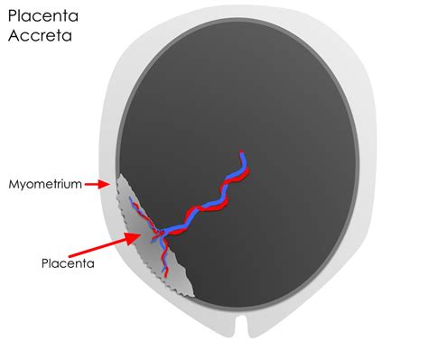 Placenta Accreta - Causes, Symptoms, Diagnosis, Risk Factors, Treatment