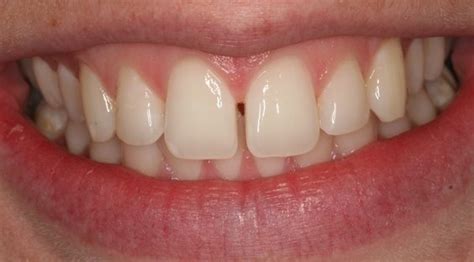 Closing Gaps in Teeth Cosmetic Dentistry Treatment - Preston Dentists