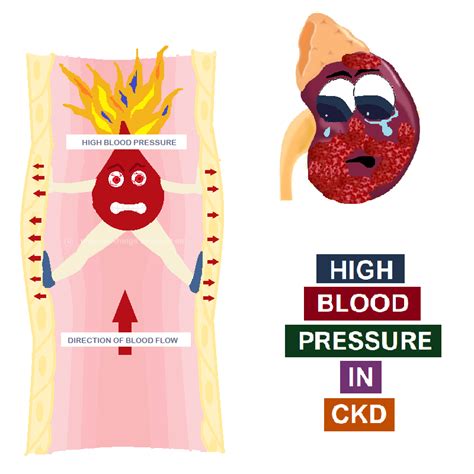 High Blood Pressure Archives - All Things Kidney ~ Official