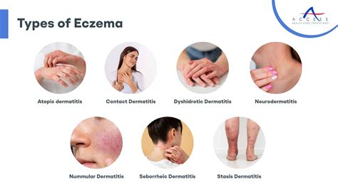 The Tell-all on Eczema | Causes, Types and Treatment