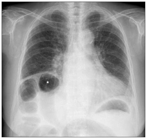 Chilaiditi syndrome • LITFL • Medical Eponym Library