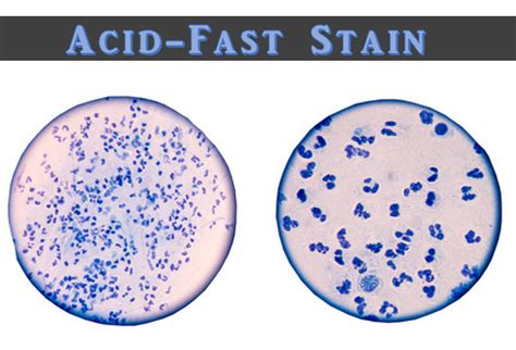 Acid Fast Stain Vs Gram Stain