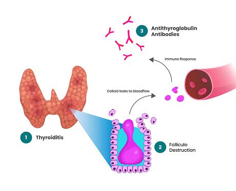 Antithyroglobulin Antibodies Stock Illustration - Download Image Now ...