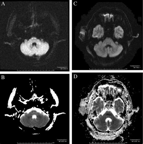 Magnetic resonance imaging of the brain demonstrating restricted ...