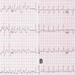 Patient's electrocardiography (ECG) showing a tall T wave, a widened ...