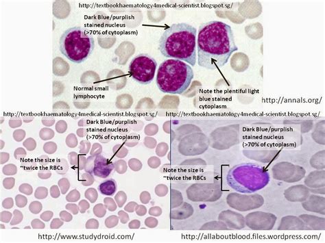 Haematology in a NutShell: Large Lymphocytes