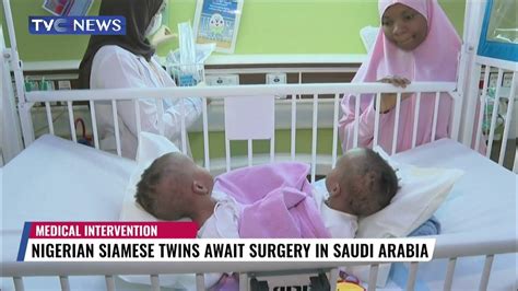 Nigerian Siamese Twins Await Surgery to Separate them in Saudi Arabia ...